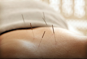 Acupuncture